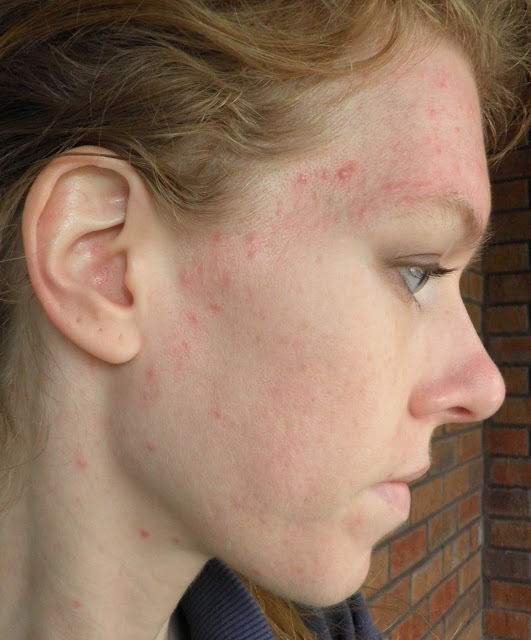 accutane use in adults accutane use in adults